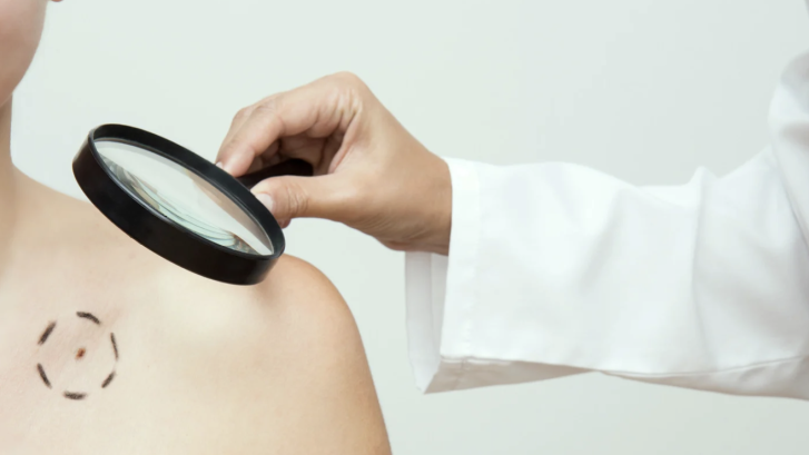Skin Cancer Screening Near Prince Frederick MD
